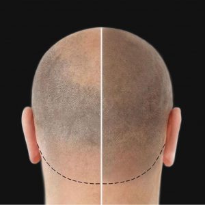 A person before and after scalp micro-pigmentation procedure.