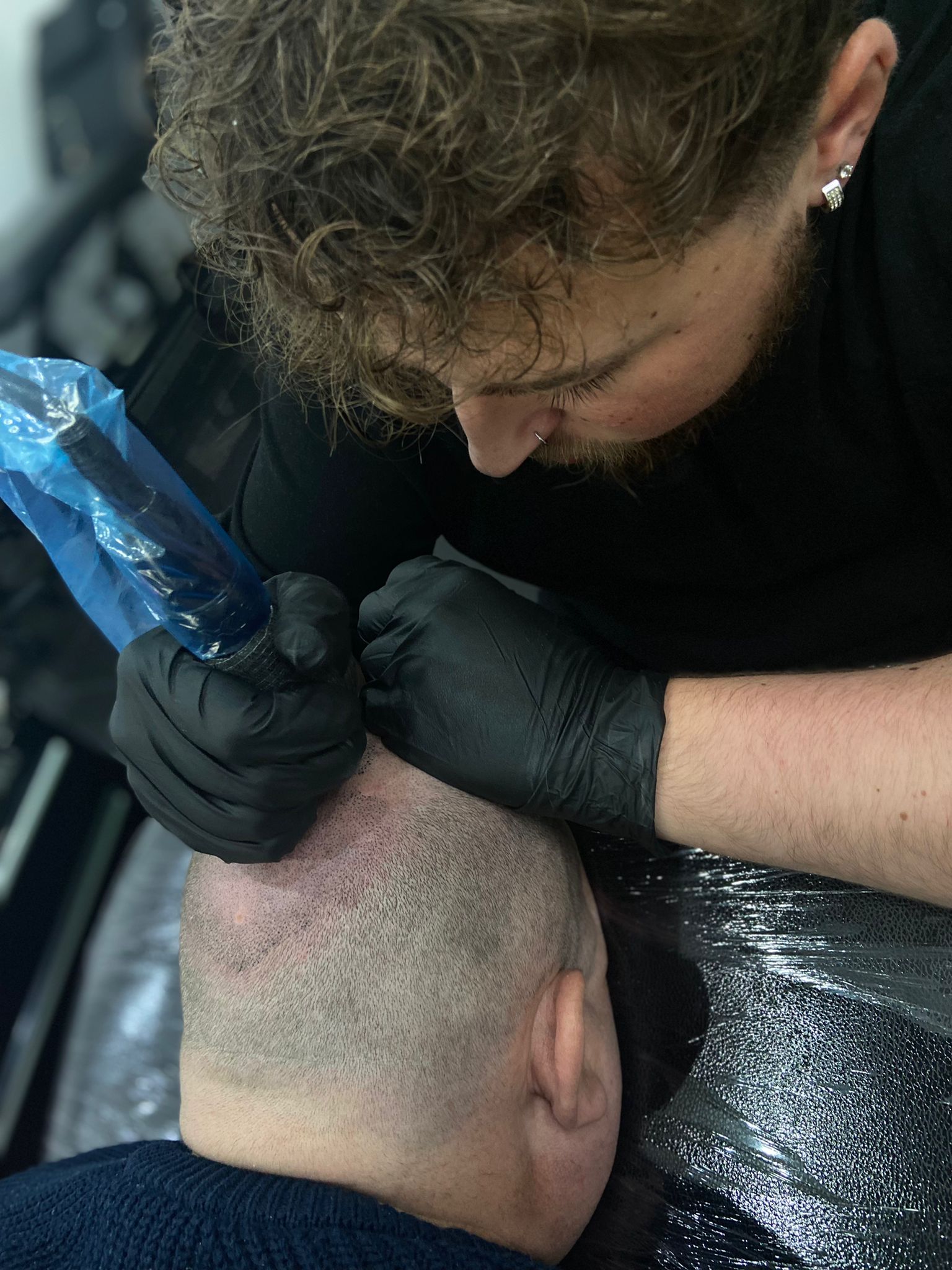 Scalp Micropigmentation